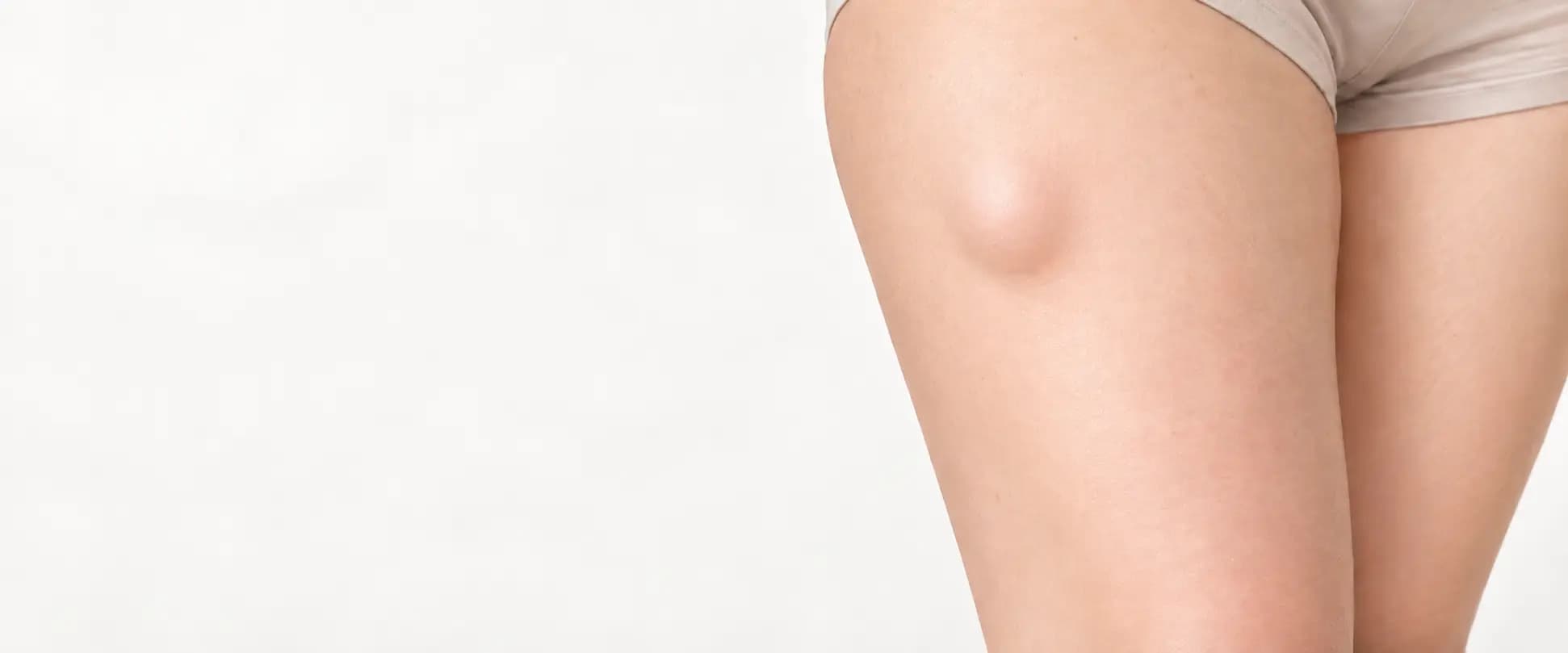 Ilustración médica de un lipoma cutáneo en el muslo, representado como un pequeño bulto subcutáneo bajo una piel de aspecto normal.