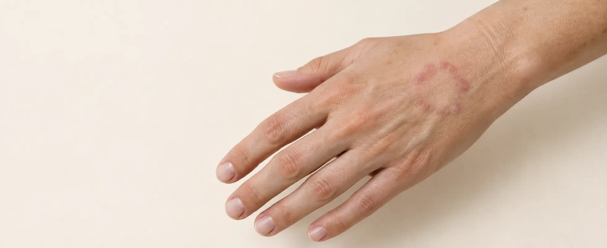 Ilustración de granuloma anular en el dorso de una mano, con pequeñas elevaciones rosadas formando un anillo irregular y discontinuo.
