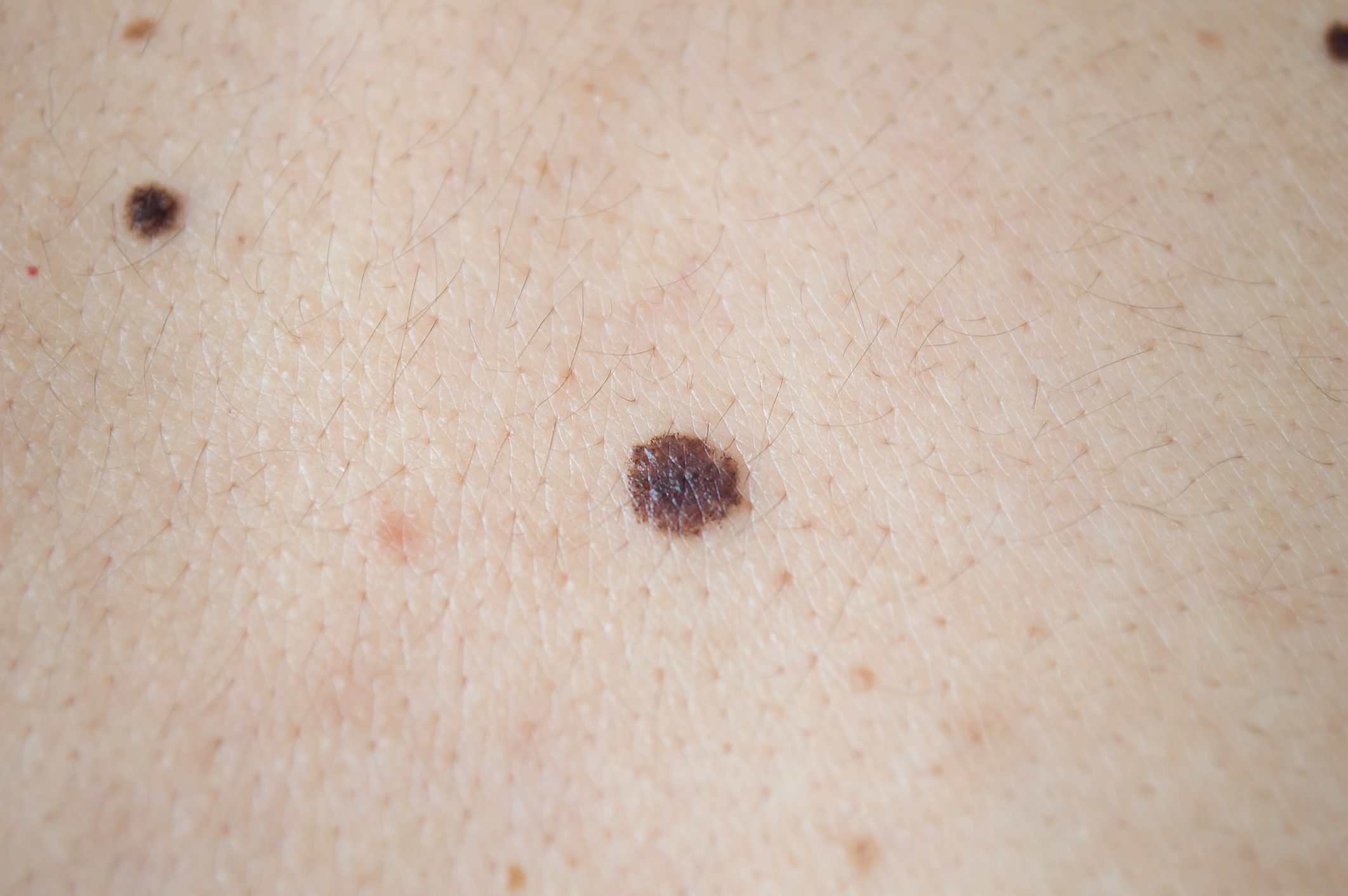 Lunares: Qué es, Beneficios y Procedimientos | Skinpaths