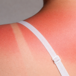 Primer plano de piel enrojecida por el sol