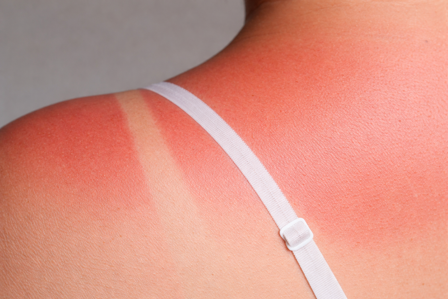 Primer plano de piel enrojecida por el sol