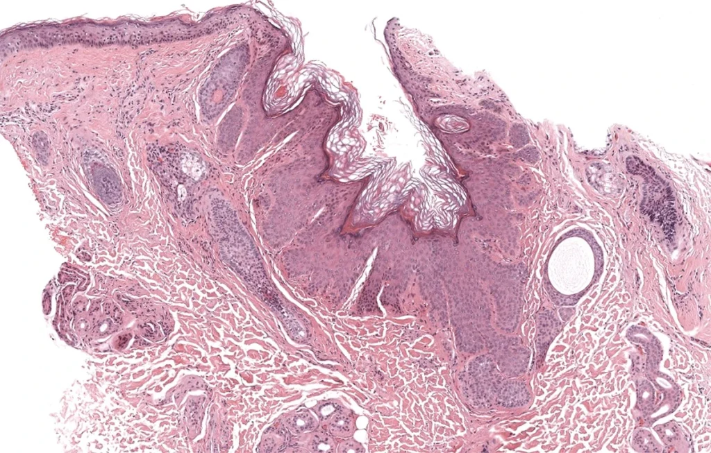 Dermatología Patológica