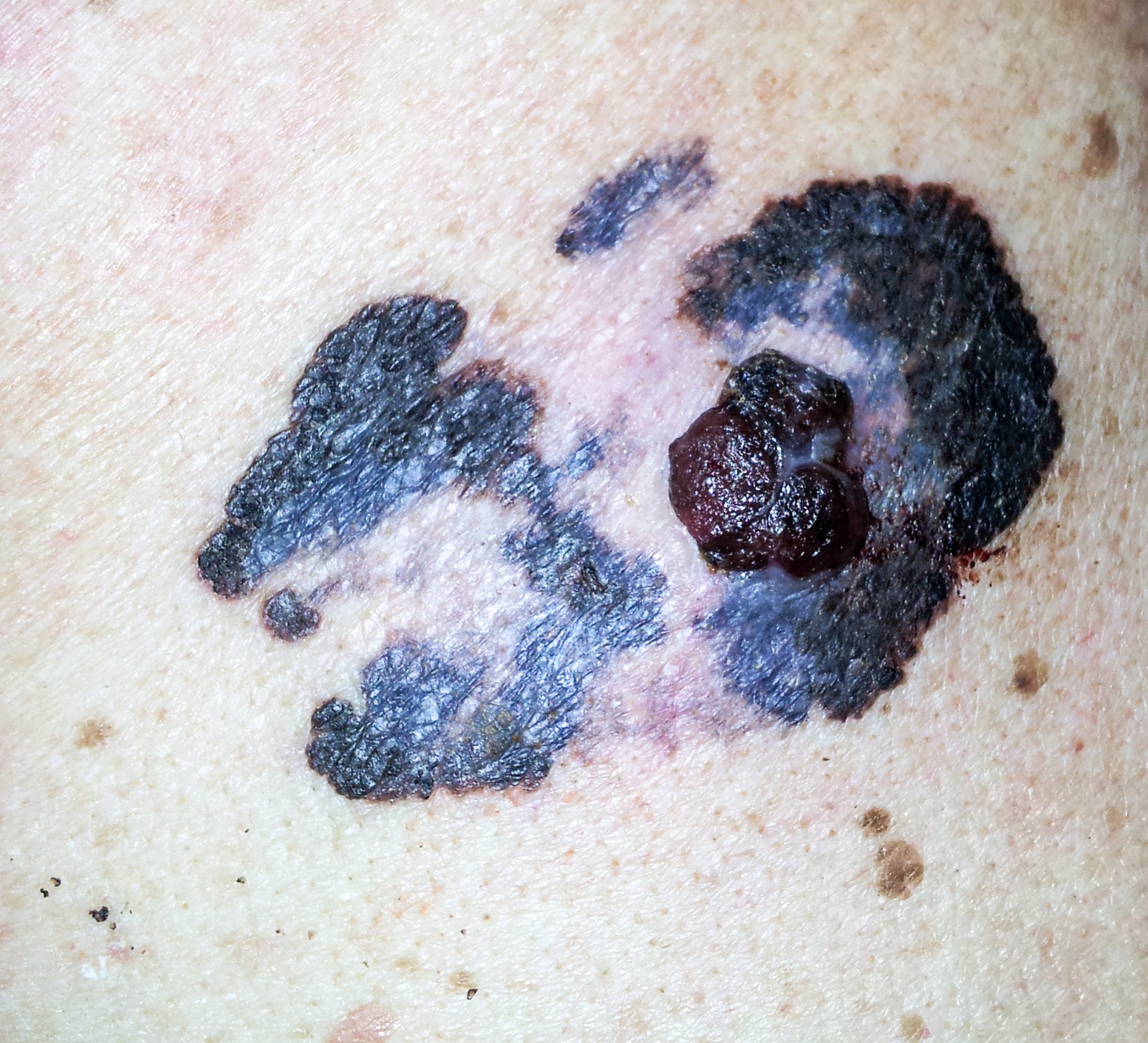 Melanoma: Qué es, Beneficios y Procedimientos | Skinpaths