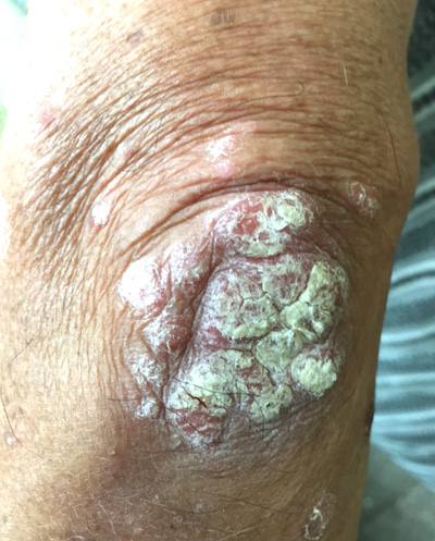 Psoriasis: Qué es, Beneficios y Procedimientos | Skinpaths