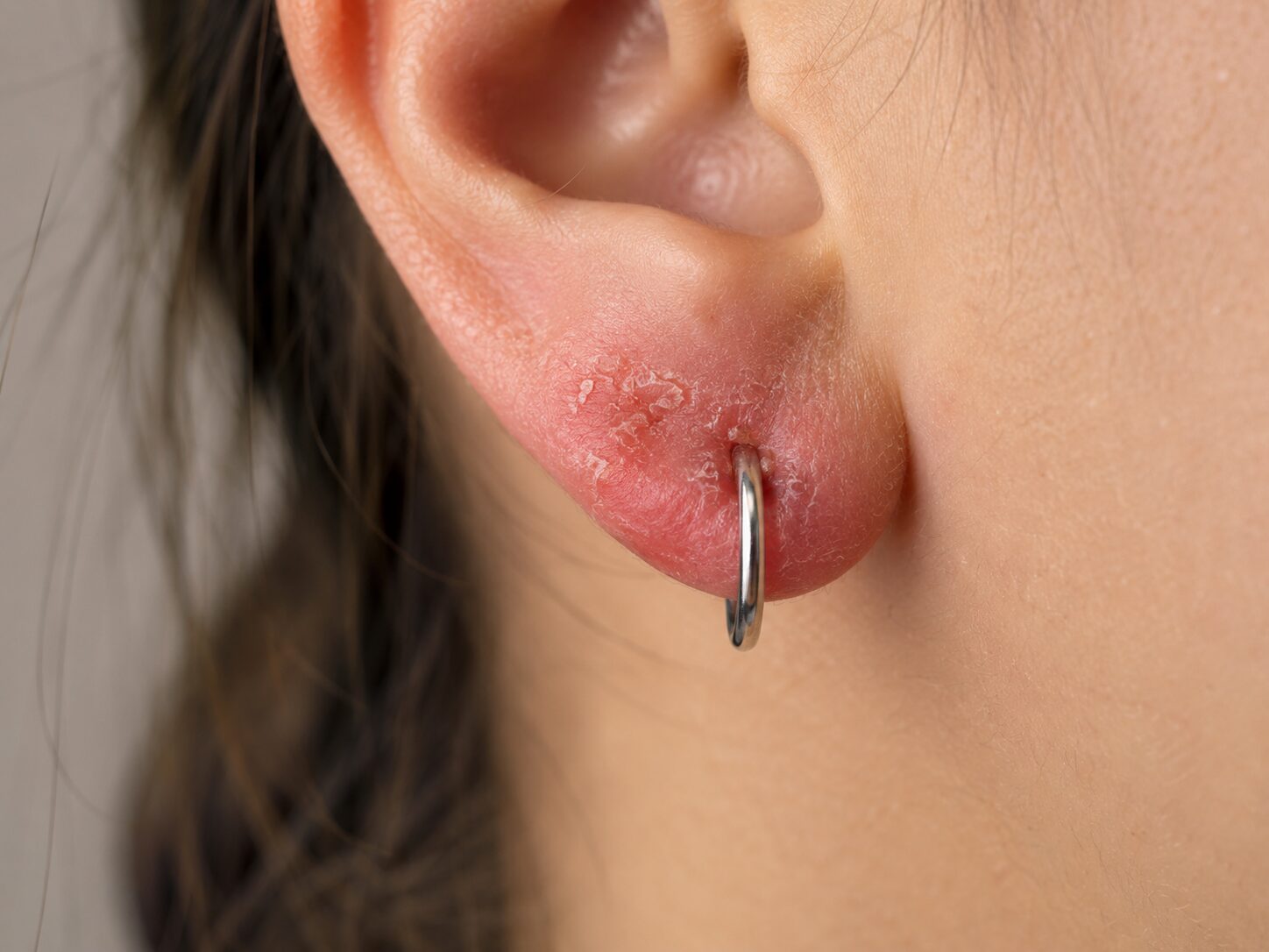 Imagen clínica de dermatitis por contacto en el lóbulo de la oreja, con enrojecimiento y descamación alrededor de un arete.