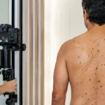Nevus displásicos: información para pacientes