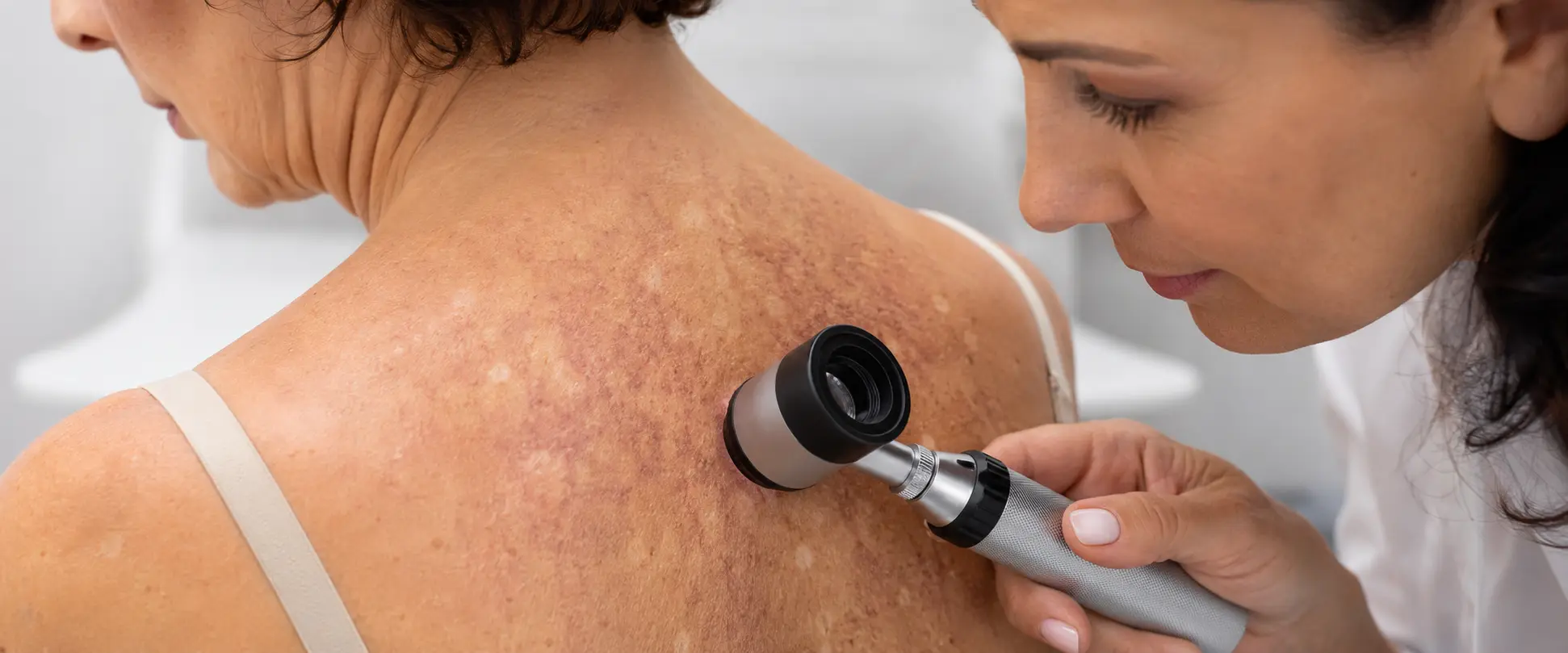 Dermatóloga evalúa con dermatoscopio una lesión poiquilodermatosa en la espalda de una mujer con sospecha de dermatomiositis.