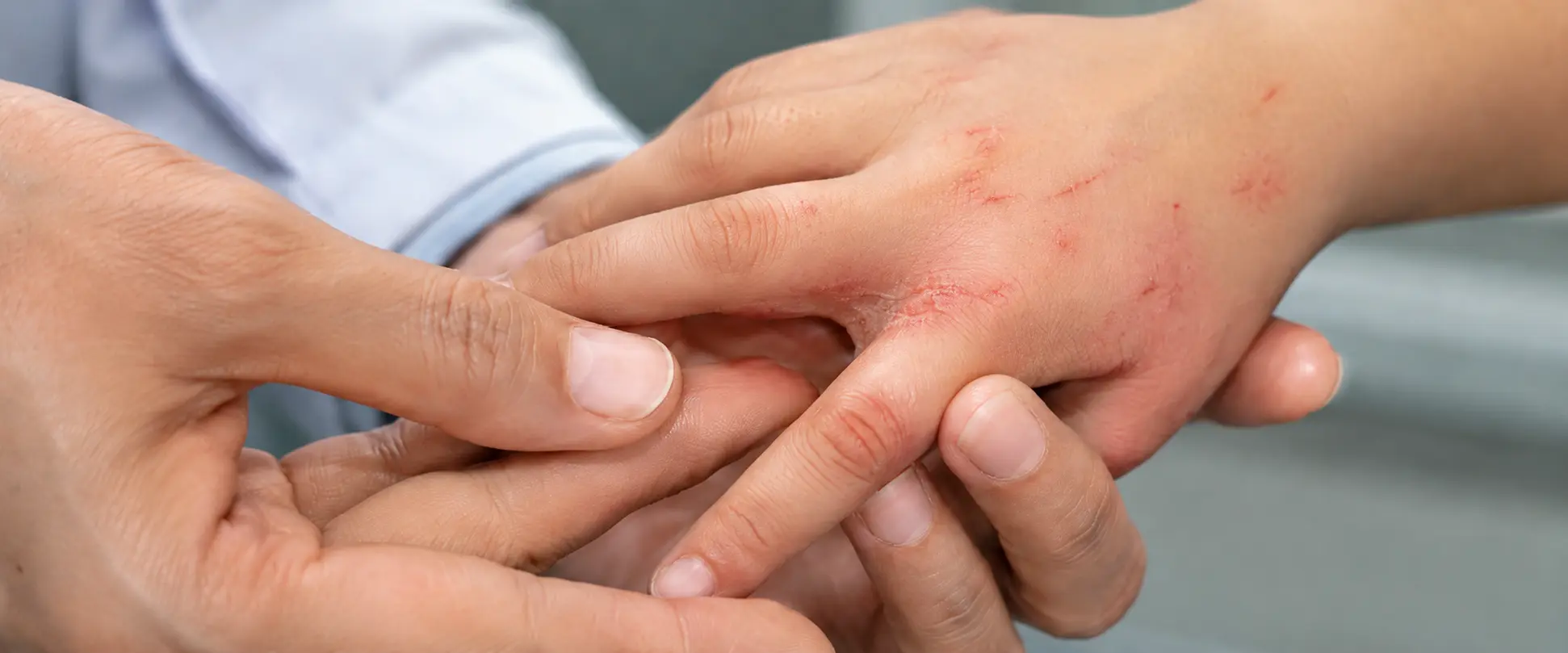 Médico examina la mano de un niño con lesiones de escabiasis, irritación interdigital y huellas de rascado.