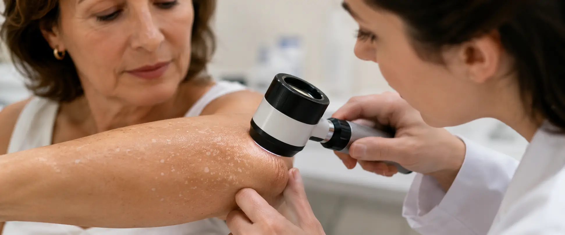 Dermatóloga examina con dermatoscopio lesiones de hipomelanosis guttata en el brazo de una mujer de mediana edad.